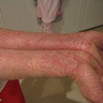 more extreme case of eczema