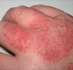 a mild case of eczema