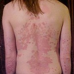 psoriasis