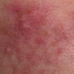 rosacea